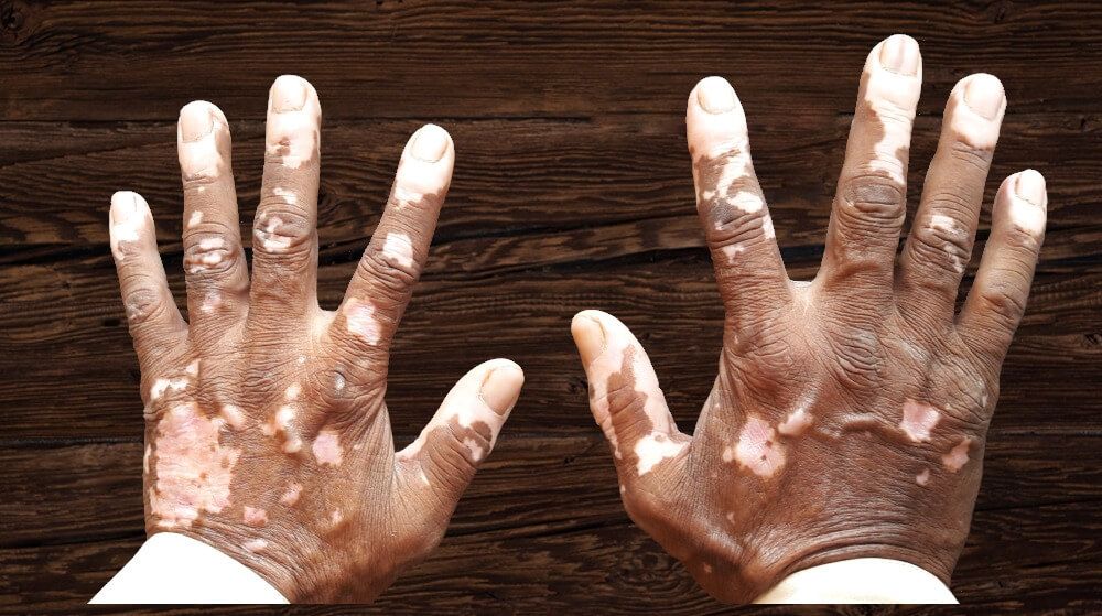 Vitiligo: Symptoms, Causes, and Treatment