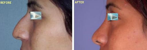 Rhinoplasty - Facial Plastic Surgery