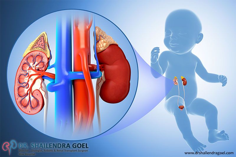 What is kidney dysplasia?
