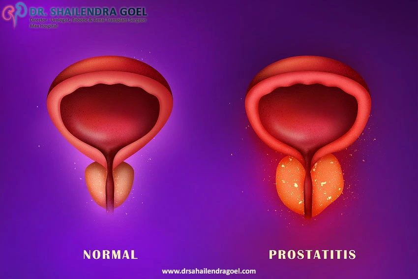 What is Prostatitis? Causes, Symptoms, and Treatment
