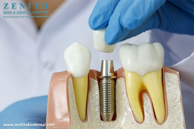 Can Dental Implants Cause Problems?