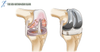 What is a total knee replacement?