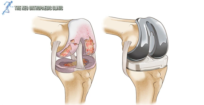 total knee replacement