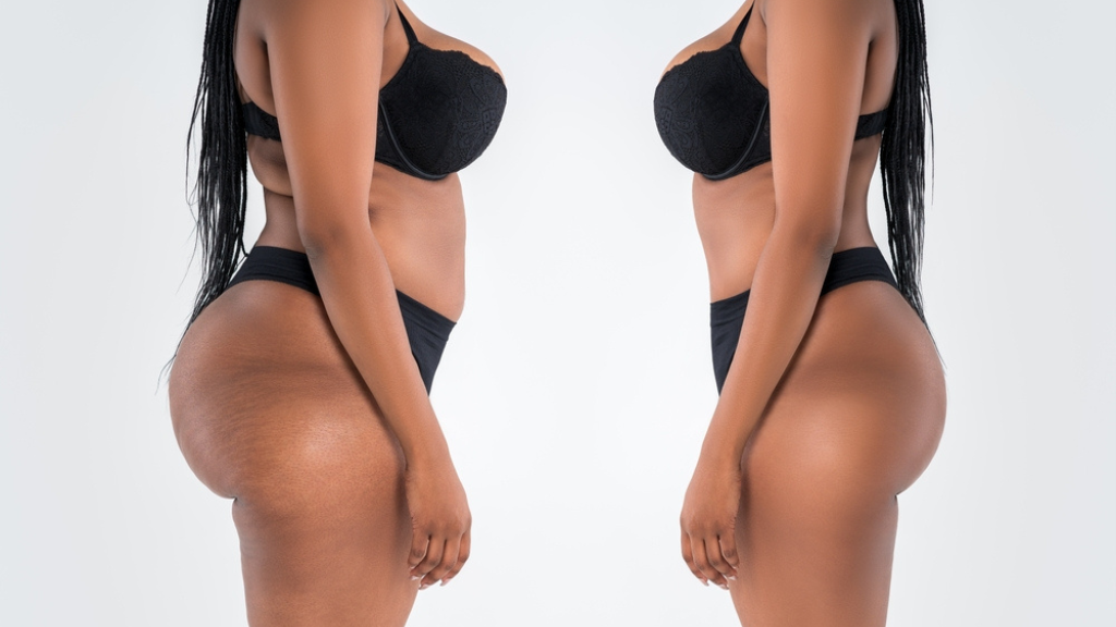 4 Things You Should Know About Liposuction